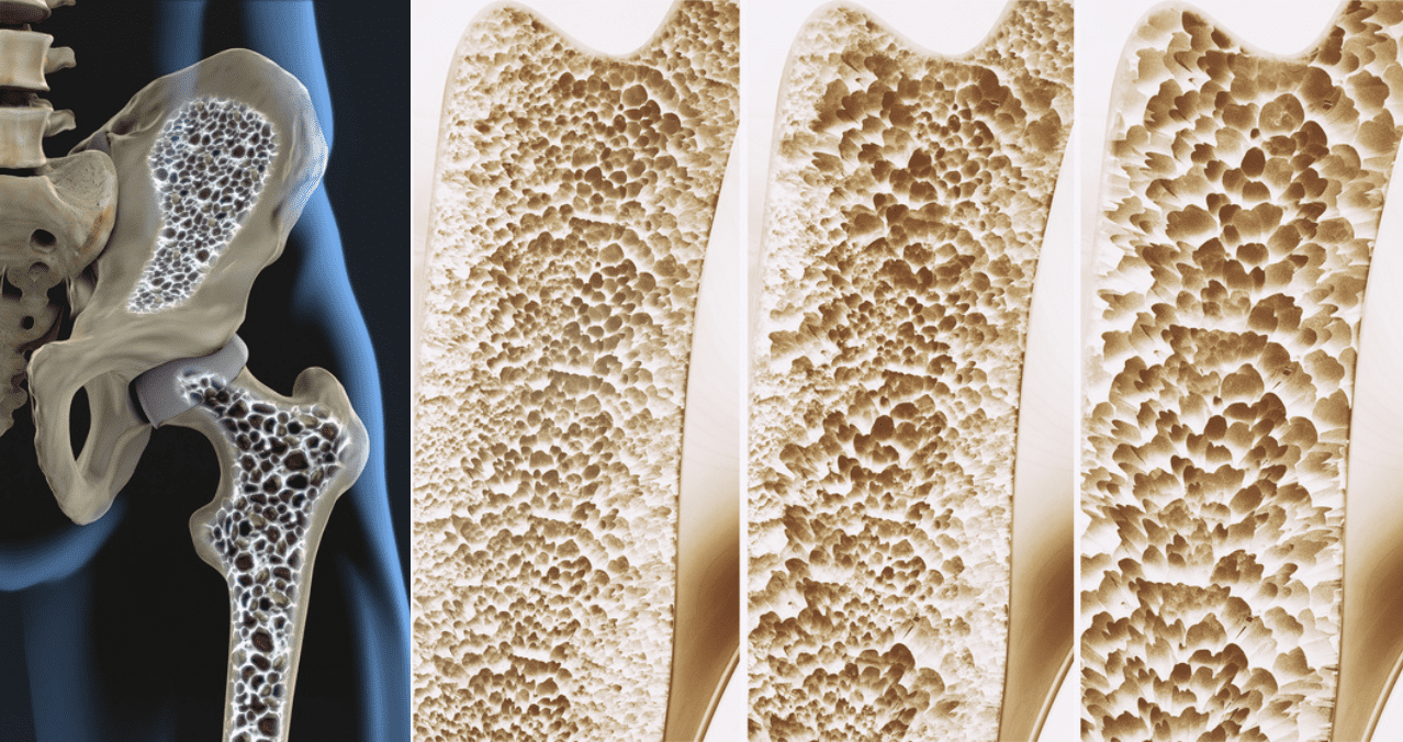 osteoporoza 1